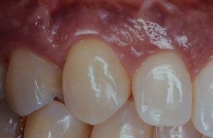 After Gum Recession